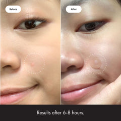 Mighty Patch™ from Hero Cosmetics - Hydrocolloid Acne Pimple Patch for Covering Zits and Blemishes